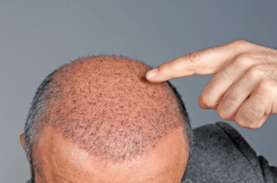 hair transplant